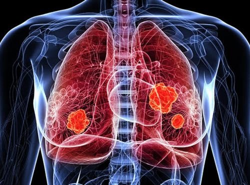 copd