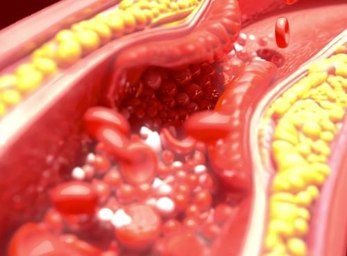 dyslipidemia